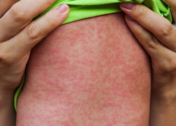 OMS alerta para aumento de casos de sarampo no mundo