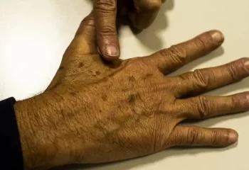 Sociedade Brasileira de Dermatologia promove mutirão gratuito para prevenção do câncer de pele