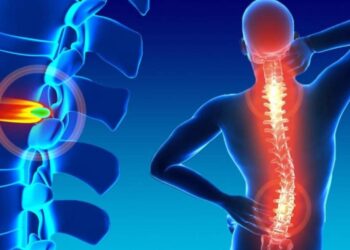 Doença que atinge 5,4 milhões de brasileiros, hérnia de disco pode ser tratada em 90% dos casos sem cirurgia