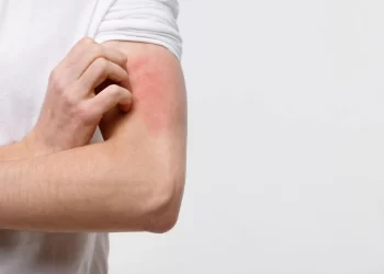 Ministério da Saúde anuncia R$ 55 milhões em ações de prevenção e tratamento da hanseníase