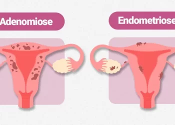 Adenomiose ou endometriose? Saiba identificar os sintomas corretamente