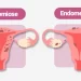 Adenomiose ou endometriose? Saiba identificar os sintomas corretamente