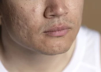 Acne na vida adulta: dicas essenciais para prevenir e melhorar o aspecto de cicatrizes