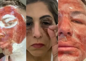 Peeling de Fenol: Nota Técnica da Sociedade Brasileira de Dermatologia