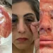 Peeling de Fenol: Nota Técnica da Sociedade Brasileira de Dermatologia