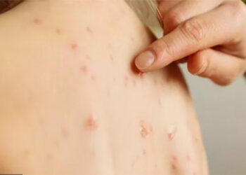 Bahia: quatro anos sem sarampo, avanço rumo à certificação nacional