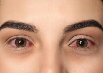 Conheça 4 tipos de conjuntivite e saiba como tratá-las