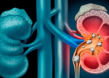 Cálculo renal: hábitos no inverno aumentam a incidência dos casos