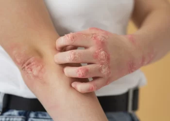 3 fatos sobre a dermatite atópica em crianças que você  precisa saber