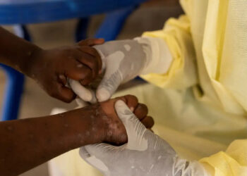 Vacina brasileira contra a mpox está próxima dos testes em humanos