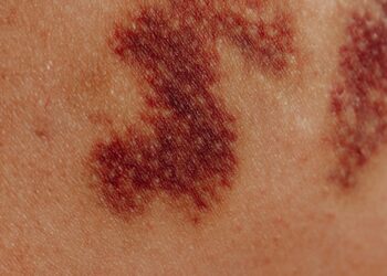 “O lúpus não é o fim da linha, é possível conquistar diversas coisas, mesmo depois do diagnóstico” declara advogada diagnosticada com a doença