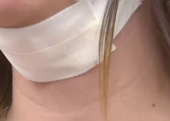 Paciente tem complicações graves após realizar “lipo da papada” com biomédica na Bahia