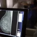 Cerca de 77 mil mulheres aguardam mamografia pelo SUS