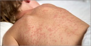 Sarampo pode causar conjuntivite e cegueira temporária