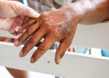 Hanseníase: entenda porque a doença ainda é um desafio no Brasil