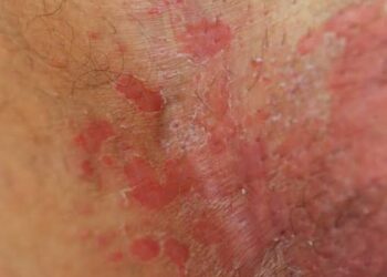 Candidíase em altas temperaturas: como prevenir a infecção em tempos de calor extremo