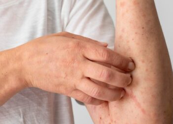 Ministério da Saúde envia equipe a São Paulo para monitorar 1º caso de mpox causado pela cepa 1b no Brasil