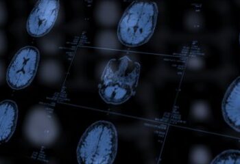 Inteligência artificial detecta anormalidades cerebrais invisíveis em pacientes com epilepsia
