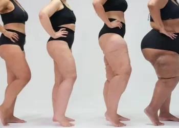 Lipedema desafia diagnóstico e impacta a saúde feminina