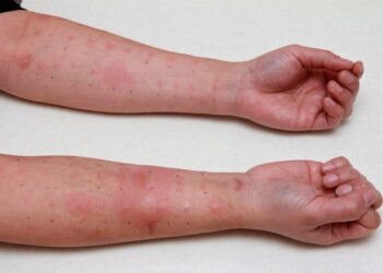 Reações alérgicas graves crescem 107% em 10 anos no Brasil: avanços e desafios no tratamento