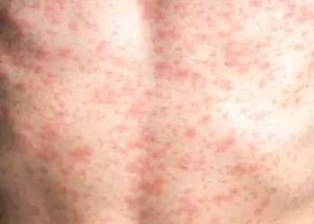 Alerta: Brasil confirma nove casos de sarampo em comunidade que recusava vacinação