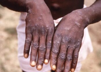 Um ano após emergência, África soma quase 50 mil casos de mpox