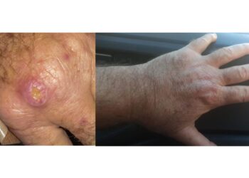 Especialistas alertam para a falta de informação sobre a leishmaniose