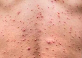 Casos de catapora aumentam 10,7% na Bahia em 2025; vacinação é a principal forma de prevenção