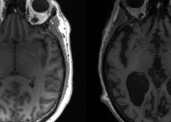 Tratamento inédito contra Alzheimer chega ao Brasil e promete frear a perda cognitiva