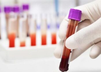 Cientistas brasileiros avançam diagnóstico de Alzheimer por exame de sangue