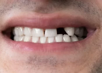 Dados do IBGE revelam que 14 milhões de brasileiros adultos vivem sem nenhum dente