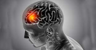 Um caso a cada 2 minutos: o que é o AVC, quais são as causas e como prevenir