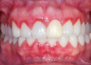 O que a gengiva revela sobre sua saúde?