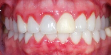 O que a gengiva revela sobre sua saúde?