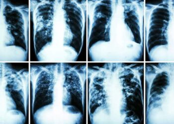 Brasil precisa acelerar resposta à tuberculose e combater estigmas que atrasam o diagnóstico