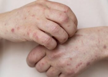 Bahia investiga novo caso suspeito de Mpox