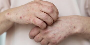 Bahia investiga novo caso suspeito de Mpox