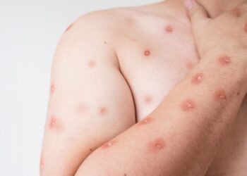 Brasil chega a 90 casos confirmados de mpox; São Paulo concentra maioria