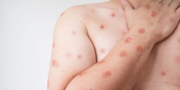 Brasil chega a 90 casos confirmados de mpox; São Paulo concentra maioria