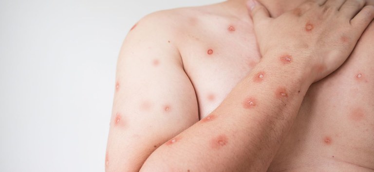 Brasil chega a 90 casos confirmados de mpox; São Paulo concentra maioria