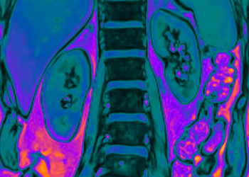 Verão: desidratação pode aumentar em 30% os casos de cálculos renais