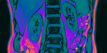 Verão: desidratação pode aumentar em 30% os casos de cálculos renais