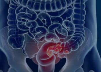 Rastreamento para câncer colorretal pode ser implementado no SUS