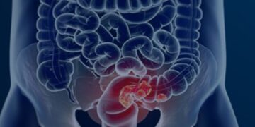 Rastreamento para câncer colorretal pode ser implementado no SUS