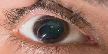 Epidemia silenciosa: 150 mil brasileiros descobrem ter ceratocone a cada ano e casos avançados acendem alerta