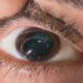 Epidemia silenciosa: 150 mil brasileiros descobrem ter ceratocone a cada ano e casos avançados acendem alerta