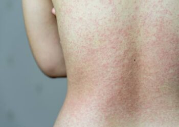Casos recentes de sarampo acende alerta para vacinação, reforça especialista do HSANP