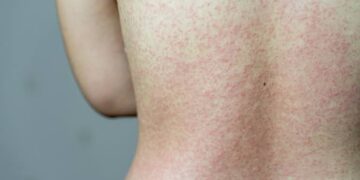 Casos recentes de sarampo acende alerta para vacinação, reforça especialista do HSANP