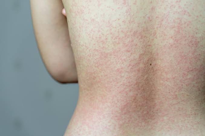 Casos recentes de sarampo acende alerta para vacinação, reforça especialista do HSANP
