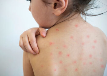 Casos recentes de sarampo reforçam alerta para vacinação, destaca infectologista do HSANP